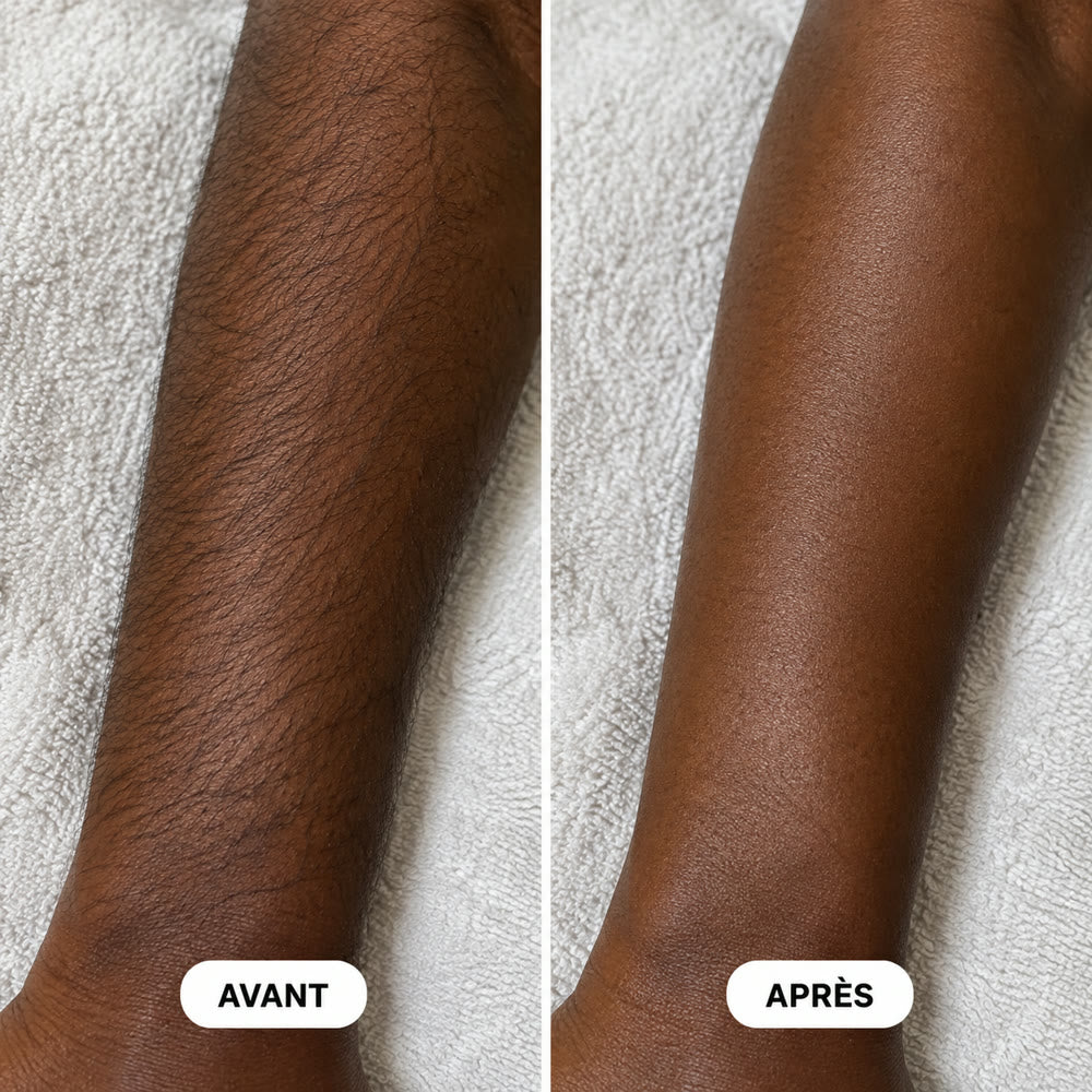 Avant-bras, avant / après